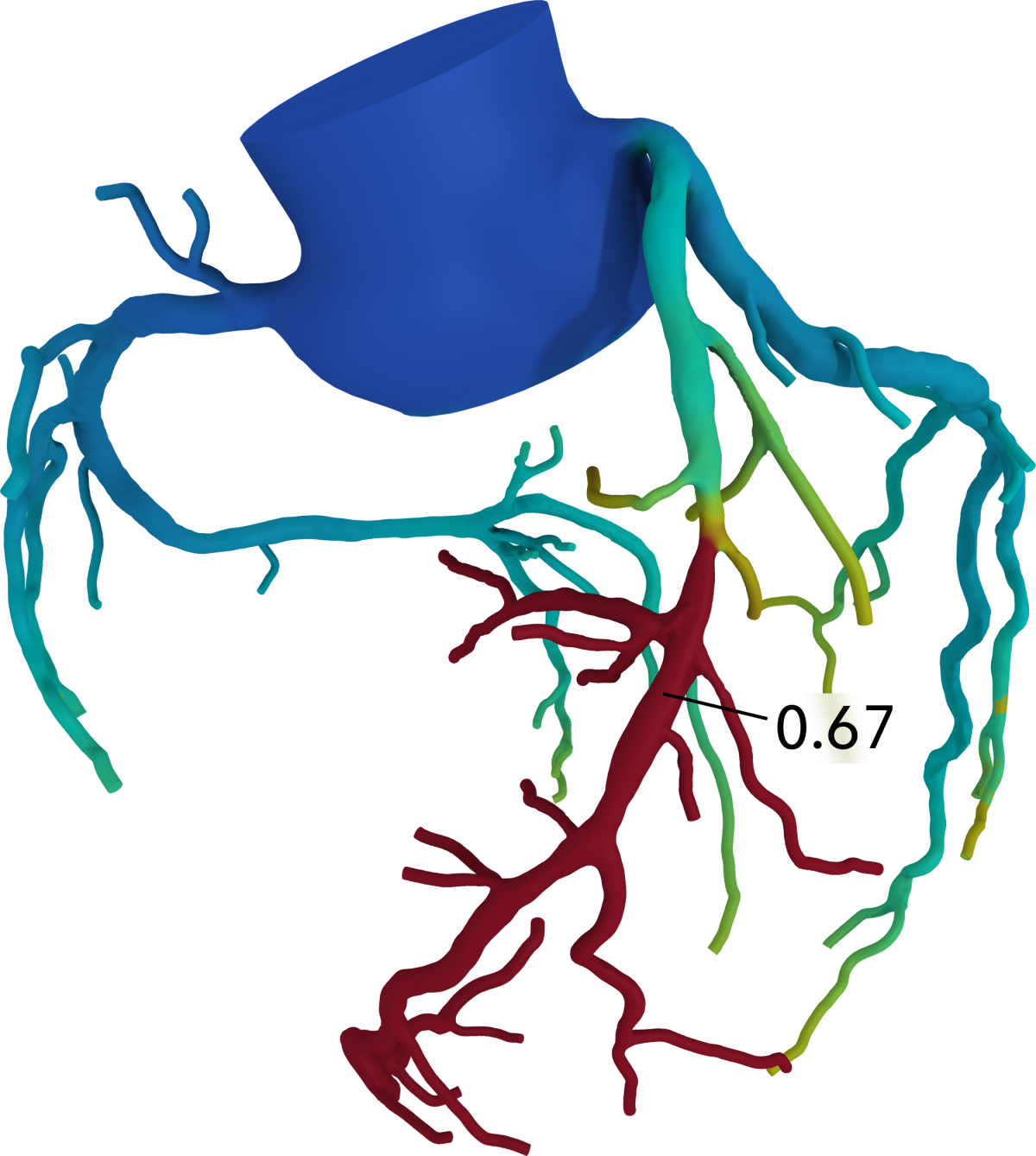 Coronary Artery Diagram