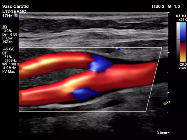 Carotid Artery Image