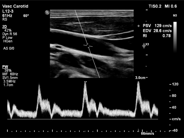 Carotid Artery Image