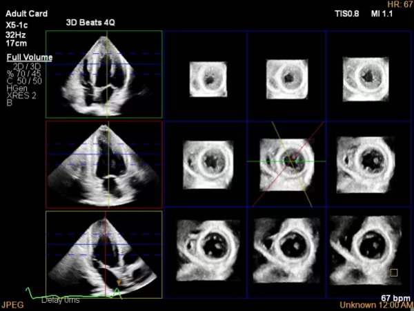 Transthoracic Echocardiogram