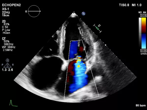 Transthoracic Echocardiogram