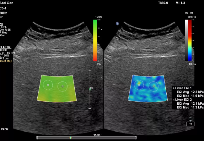 Liver Fat Image